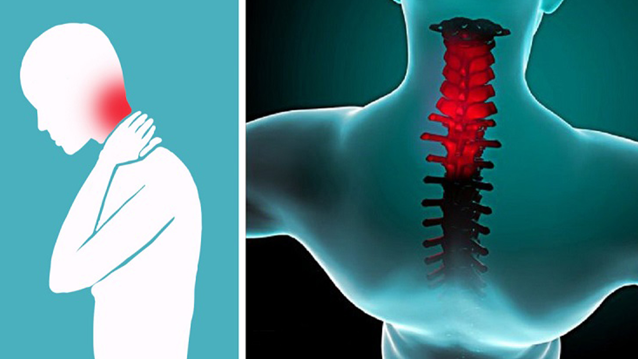 Боль в шее и слабость. Шейный остеохондроз мигрень. Шейный радикулит. Боль в шейном отделе позвоночника.