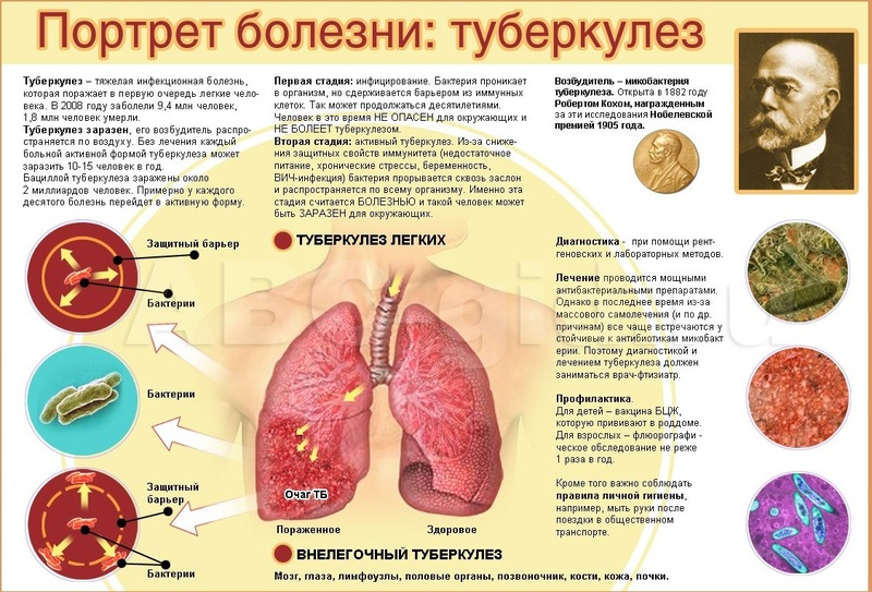 Вторичный туберкулез: Формы и методы лечения