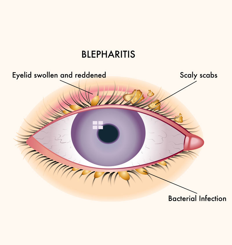 Блефарит: Симптомы и лечение